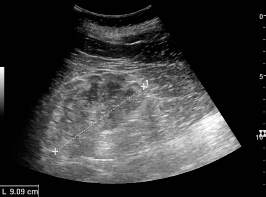 Kidney disease often lacks symptoms until it is at an advanced stage.