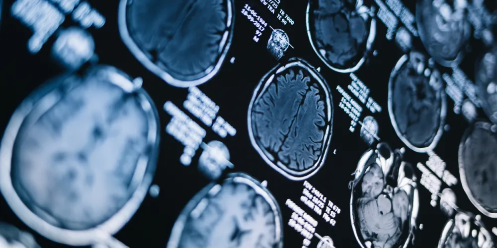 Drugs that target amyloid beta proteins in the brain likely have no clinically meaningful positive effects, while increasing the risk of bleeding and swelling in the brain, a new Cochrane review has found.