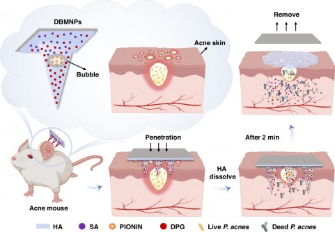 Tiny Bubbles Under the Skin: The Acne Patch That Rewrites Drug Delivery Tiny Bubbles Under the Skin: The Acne Patch That Rewrites Drug Delivery
