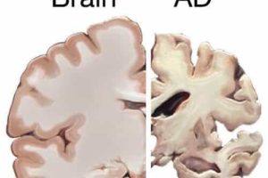 Alzheimer's disease could be transmissable like prion illness