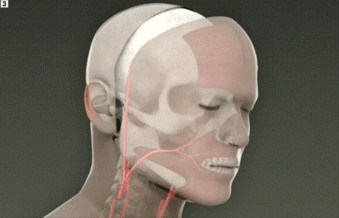 facial transplant illustration