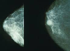 Common cause for breast cancer and heart disease?