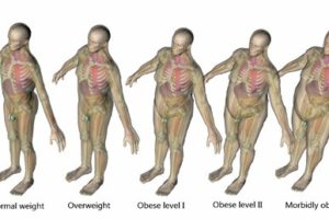Obese Patients Face Higher Radiation Exposure From CT Scans—But New Technology Can Help