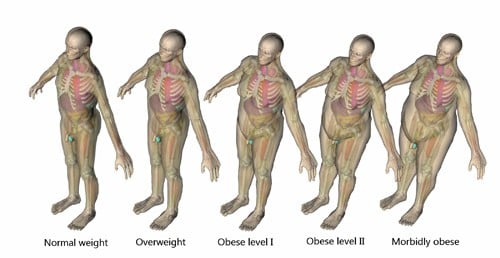Obese Patients Face Higher Radiation Exposure From CT Scans—But New Technology Can Help