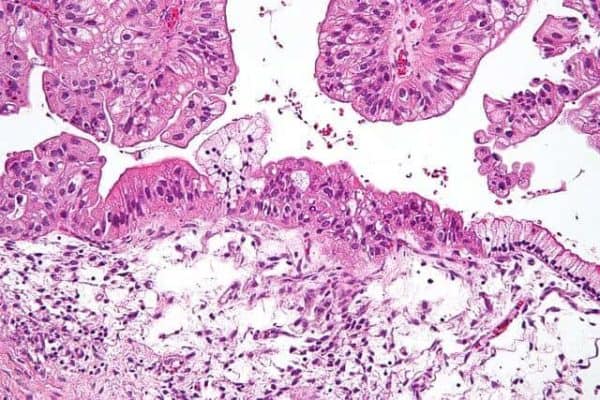 Artificial intelligence predicts ovarian cancer therapy responses