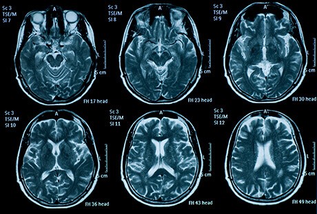 Brain mapping method illuminates targets for treating neuropsychiatric  symptoms 