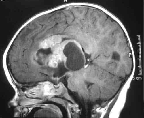 Childhood Brain Tumors Affect Working Memory of Adult Survivors ...