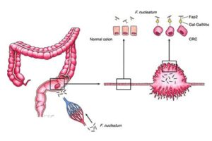 At left, colon with a tumor. Magnification at right: healthy colon tissue and colon cells, and colorectal cancer and colorectal cancer cells. Colorectal cancer cells express high levels of a sugar called Gal-GalNac. Some fusobacteria express a protein called Fap2, which helps Gal-GalNac stick to tumors where it may promote cancer growth and make the immune system less able to fight cancer. 