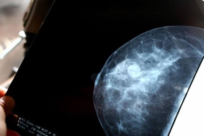 Some breast cancer patients with low genetic risk could skip chemotherapy