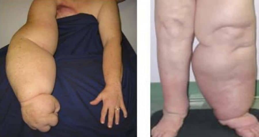 First Possible Drug Treatment for Lymphedema