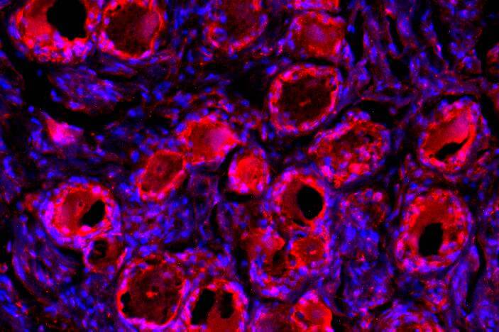 Immunotherapy Target Suppresses Pain to Mask Cancer