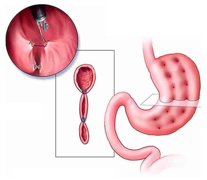 https://scienceblog.com/wp-content/uploads/2017/05/endoscopic-sleeve-gastroplasty-690x600.jpeg