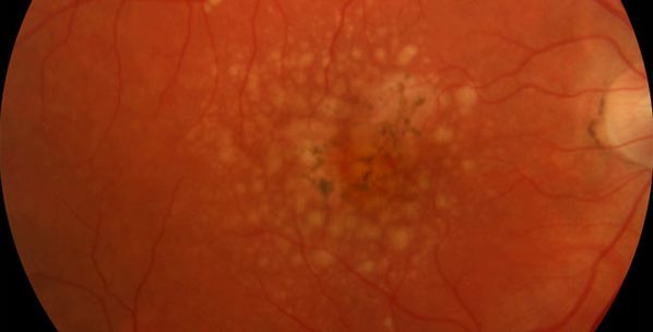 Researchers ID potential biomarkers of age-related macular degeneration