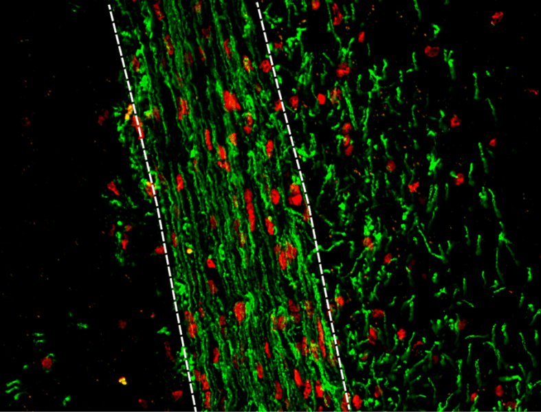 New drug target for remyelination in MS