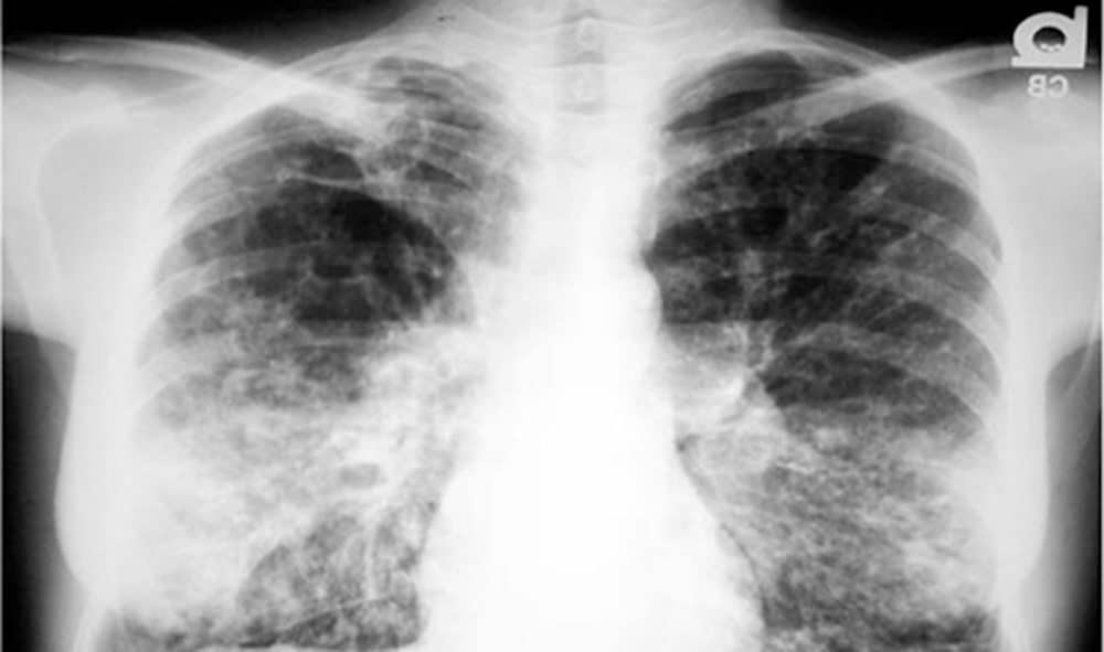 Antibiotic effectiveness for cystic fibrosis may be ...