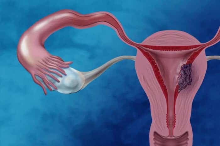 Pictured is an illustration of endometrial cancer, showing a tumor growing inside a uterus. A new study offers a road map to understanding the molecular underpinnings of endometrial cancer, which could lead to new therapies. The national research team was co-led by investigators at Washington University School of Medicine in St. Louis.