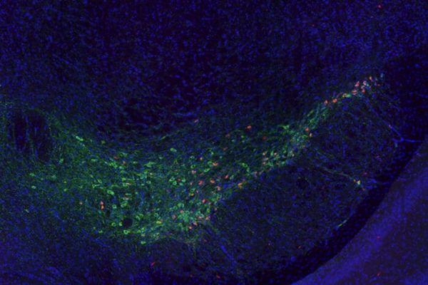 Vascular defects appear to underlie the progression of Parkinson's disease