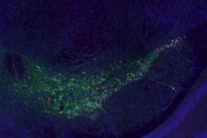 Clumps of the Parkinson’s protein alpha-synuclein (red) are visible inside neurons (green) in the brain of a mouse. Researchers at Washington University School of Medicine in St. Louis have discovered that the genetic variant APOE4 – long linked to dementia – spurs the spread of harmful clumps of Parkinson’s proteins through the brain. The findings suggest that therapies that target APOE might reduce the risk of dementia for people with Parkinson’s disease.