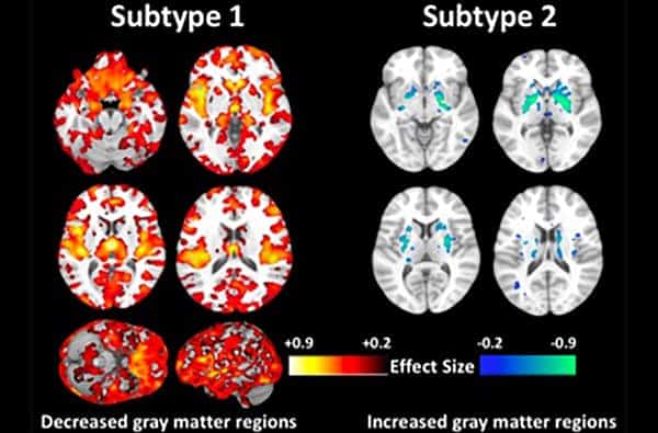 Sixty percent of patients with schizophrenia (subtype 1) had decreased gray matter volumes throughout the brain compared to healthy people, which is the typical pattern seen in those with this disorder. However, researchers found that more than a third of schizophrenia patients (subtype 2) did not present with this pattern. These brains had increased volumes of gray matter in the basal ganglia, but were otherwise similar to healthy controls. (Image: Penn Medicine News)