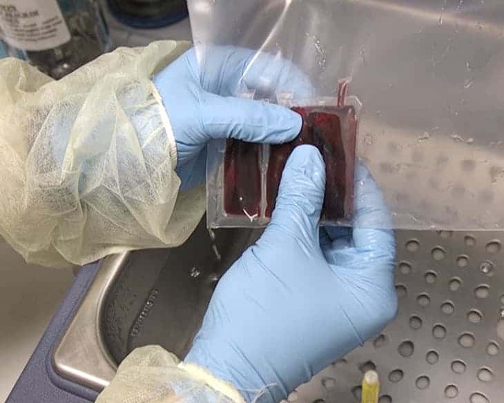 Cord Blood Study Provides Insights on Benefits, Limitations for Autism Treatment