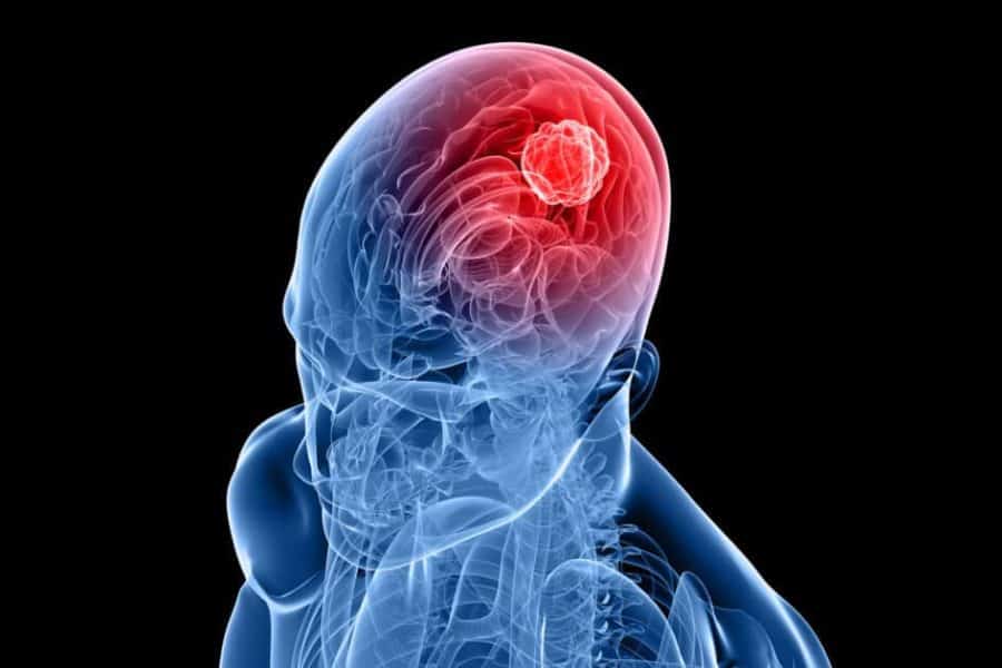 Targeted drug combo unprecedented against highly aggressive brain tumors