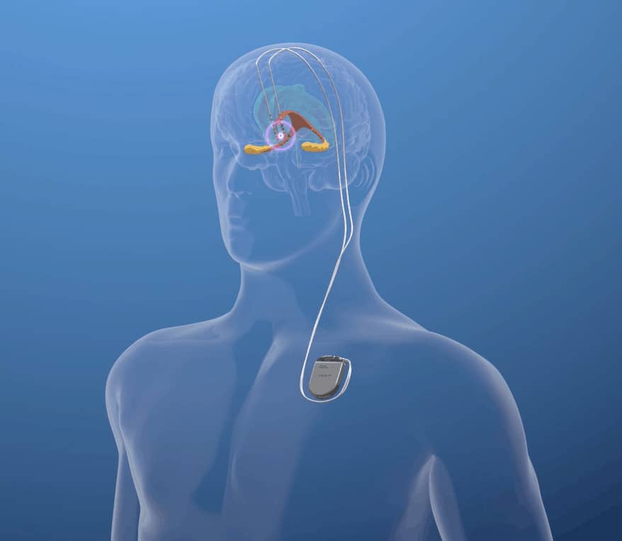 New Clinical Trial Will Test Deep Brain Stimulation As Alzheimer’s ...