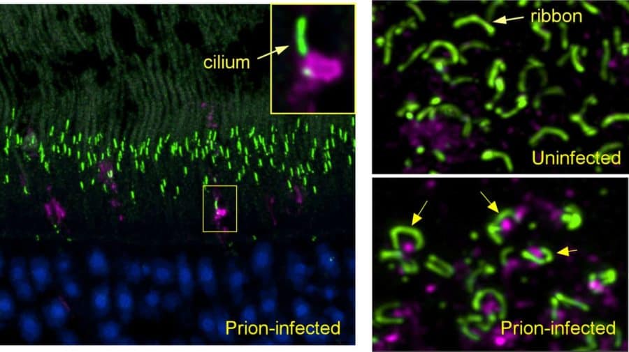 Scientists identify locations of early prion protein deposition in retina