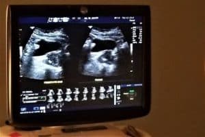Kidney stone ultrasound