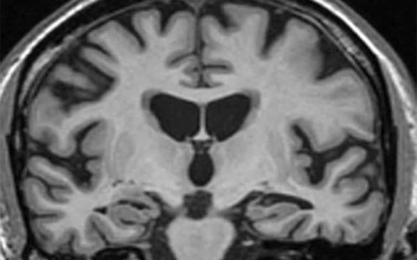 Blood protein interacts directly with nerve cells to cause brain inflammation