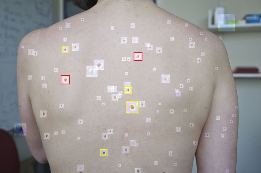How it works: A wide-field image, acquired with a smartphone camera, shows large skin sections from a patient in a primary-care setting. An automated system detects, extracts, and analyzes all pigmented skin lesions observable in the wide-field image. A pre-trained deep convolutional neural network (DCNN) determines the suspiciousness of individual pigmented lesions and marks them (yellow = consider further inspection, red = requires further inspection or referral to dermatologist). Extracted features are used to further assess pigmented lesions and to display results in a heatmap format.