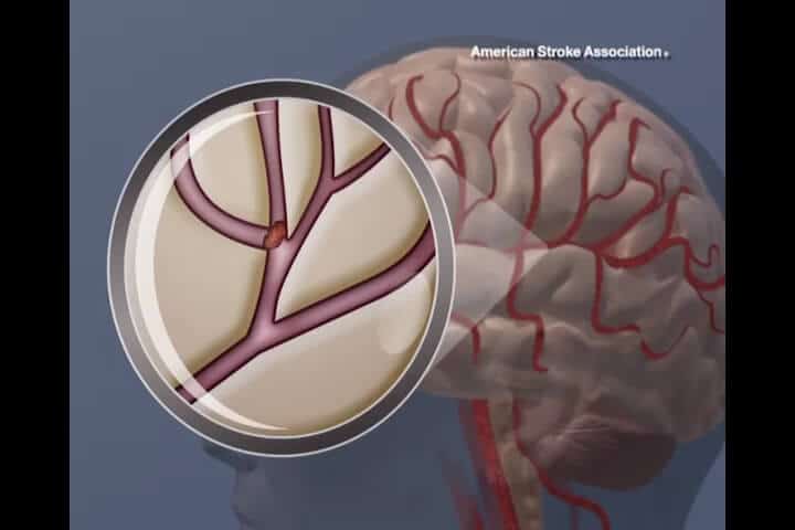 Obsessive compulsive disorder linked to increased ischemic stroke risk later in life