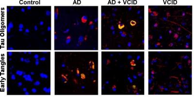 Forget me not: Novel target shows promise in treating Alzheimer's and related dementias