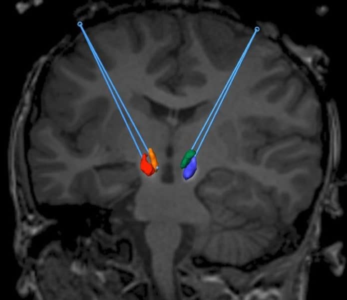 A corrected gene is placed in the midbrain of a patient with AADC deficiency. Image credit: UCSF