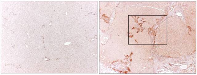 Normal liver tissues (left) do not produce mesothelin, while liver tissue from patients with primary sclerosing cholangitis do (right, darker staining). Mesothelin is a marker of liver fibrosis, and the target of a potential new therapy for liver disease.
