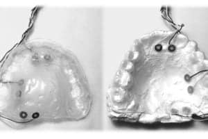 Top and bottom view of a retainer containing electrodes for intraoral electrical stimulation.