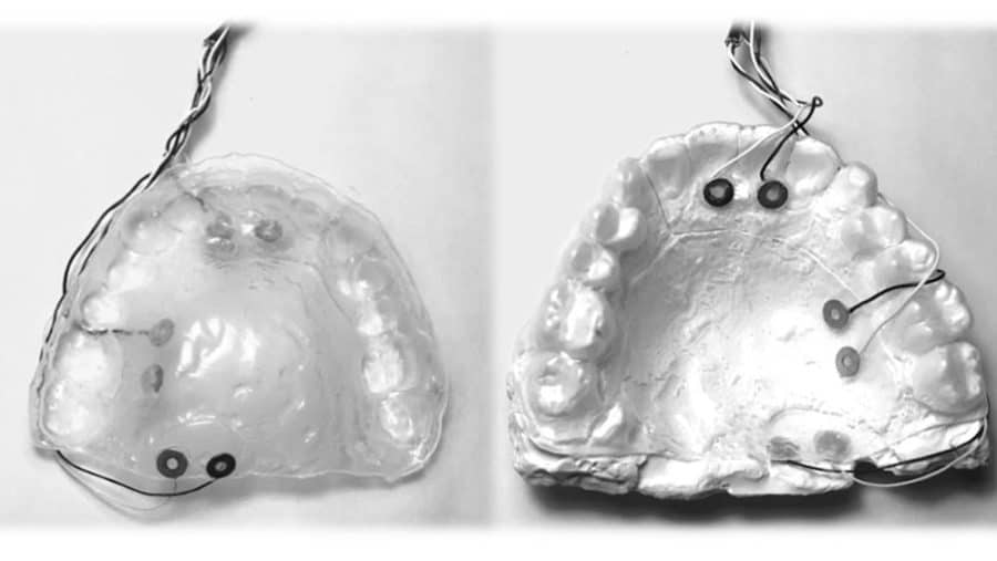 Top and bottom view of a retainer containing electrodes for intraoral electrical stimulation.