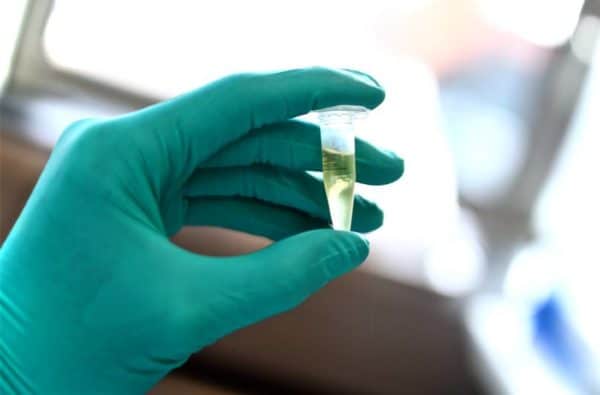 Brain Fluid Analysis Reveals Potential Drug Targets for Alzheimer’s