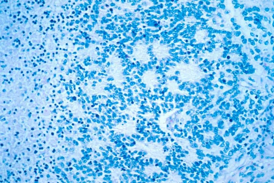 A microscopic view of a typical neuroblastoma. Courtesy of National Cancer Institute.
