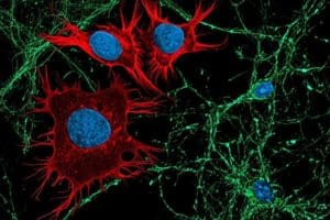 The image depicts neurons (green) in co-culture with medulloblastoma cells (red). Phenotypically, two contrasting cell types – the former normal and quiescent, while the latter cancerous and proliferating. Martirosian et al., through the perspective of cancer neuroscience, now provide evidence that rare cells in this pediatric brain tumor masquerade like quiescent neurons and exploit a neurotransmitter metabolic pathway to survive in the cerebrospinal fluid and promote leptomeningeal metastases. (Image/Vahan Martirosian, Josh Neman)