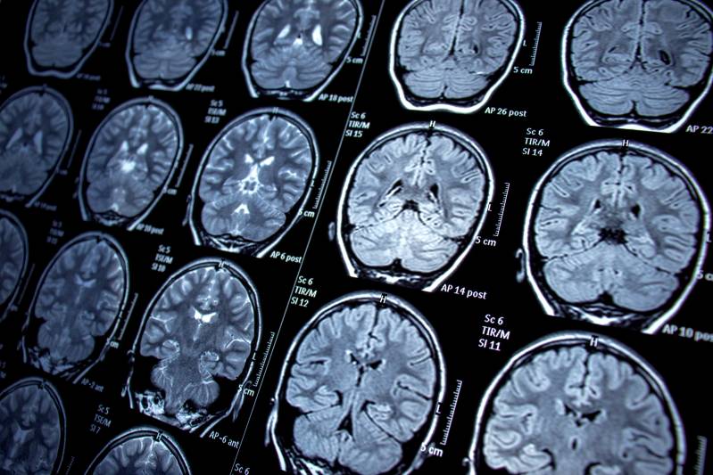 Artificial Intelligence May Find Signs Of Alzheimer’s In Neuroimaging Data