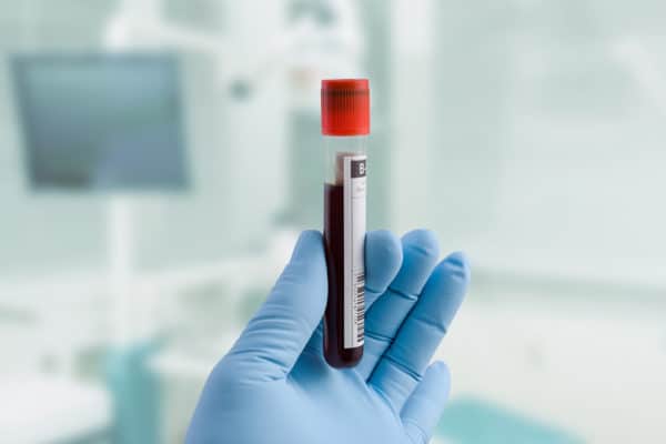 Blood test detects toxic Alzheimer’s protein years before symptoms