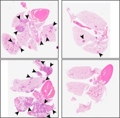 By putting cancer cells to sleep, new drug could prevent tumor metastasis