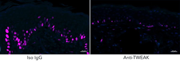 Suffering from psoriasis? Blame this trio of proteins