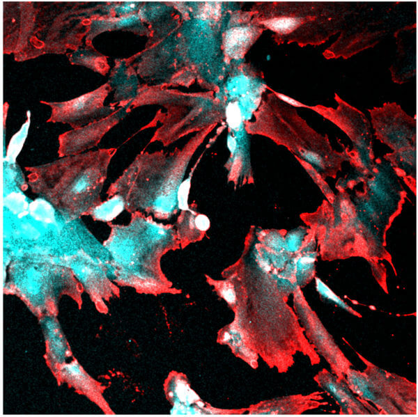 Fluorescent microscopy image showing robust uptake of SARS-CoV-2 by human stem cell-derived kidney podocytes. The infected cells express viral nucleocapsid protein (Red) and the podocyte cell lineage identification marker, nephrin (Cyan).