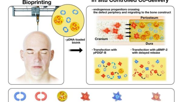 Bioprinting during surgery of bone constructs used as a controlled gene co-delivery platform for the repair of skull defects. Credit: Dong Heo, Kyung Hee University; Ozbolat Lab, Penn State. / Penn State. Creative Commons