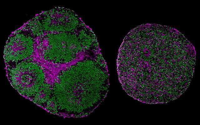 Microscopy images reveal significant differences in size and structure between brain organoids derived from a patient with Pitt-Hopkins Syndrome (right) and from a control (left).