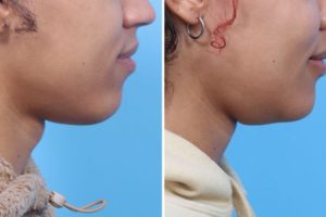 Before (left) and after (right) photos of a patient who udnerwent a scarless transoral chondrolaryngoplasty (TOC) procedure. Images by Rahul Seth