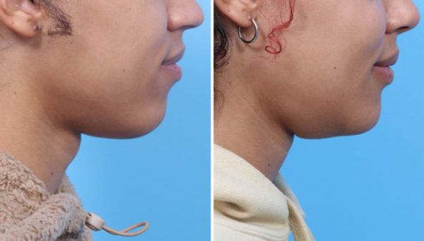 Before (left) and after (right) photos of a patient who udnerwent a scarless transoral chondrolaryngoplasty (TOC) procedure. Images by Rahul Seth