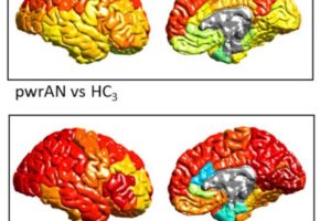 Compiled from worldwide brain scans in the largest study to date, these brain maps show (in warmer colors) brain regions with gray matter deficits—abnormal tissue reductions—in anorexia. Deficits are less strong in partially-weight restored individuals (upper images) than those in the acute phase (lower images) suggesting the importance and benefits of early interventions.