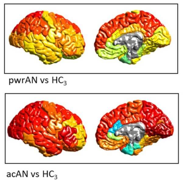 Compiled from worldwide brain scans in the largest study to date, these brain maps show (in warmer colors) brain regions with gray matter deficits—abnormal tissue reductions—in anorexia. Deficits are less strong in partially-weight restored individuals (upper images) than those in the acute phase (lower images) suggesting the importance and benefits of early interventions.